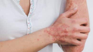 Psoriasi